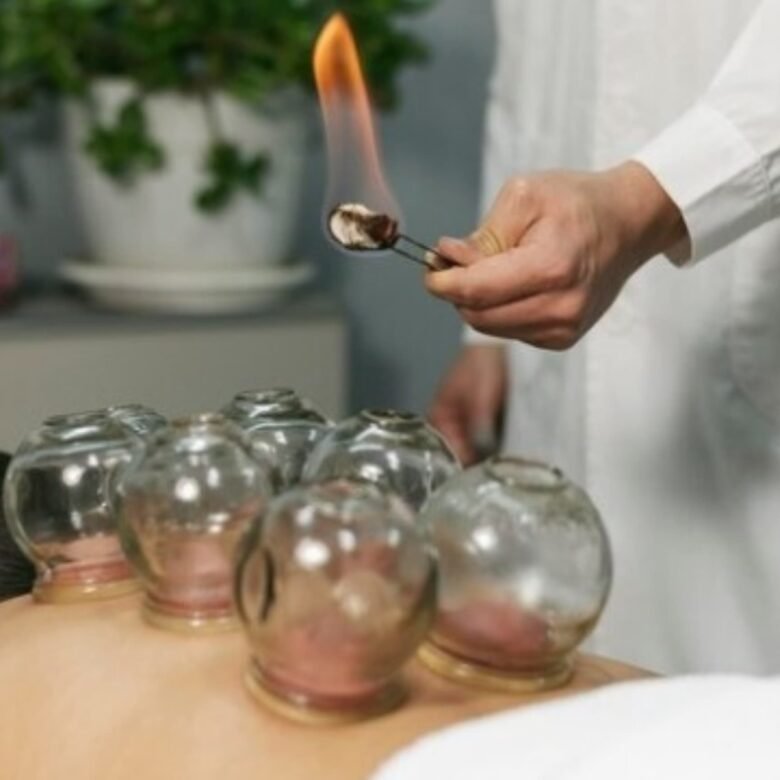 Fire cupping therapy